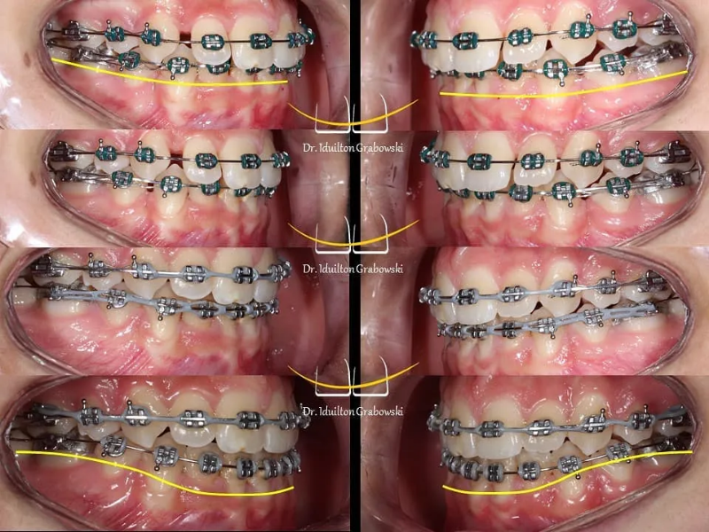 Снимка на Лечение на Клас II малоклузия – съвременни подходи от детска до зряла възраст