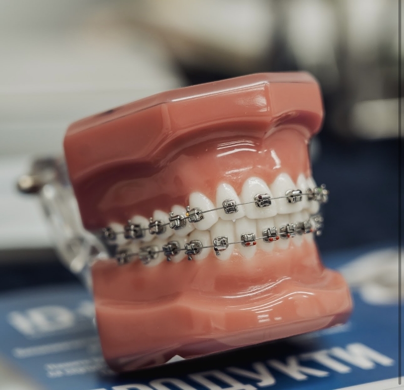 Снимка на Основи на биомеханиката в ортодонтията. Концепции на пасивните самолигиращи брекети.