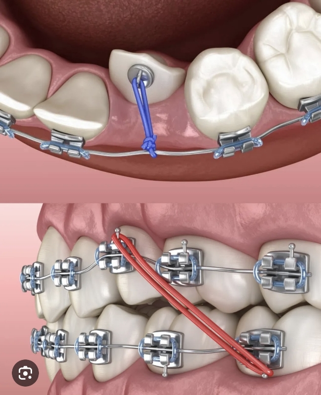 Снимка на Еднодневен курс Интермаксиларни ластици в ортодонтията – видове, приложение и клинични стратегии