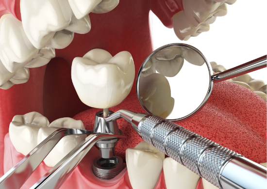 Снимка на Диагностициране на пародонтални и периимплантни заболявания