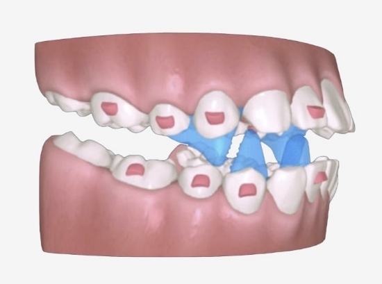 Снимка на Лечение на деца с алайнери. Вертикални проблеми. Двудневен курс.