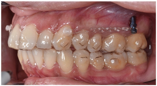 Снимка на Мини импланти и алайнери - Невидимата дигитална ортодонтия и скелетна опора