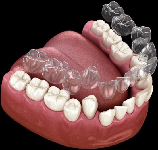 Снимка на Въведение в света на невидимата ортодонтия. Протокол за трансверзални отклонения. Биомеханика с алайнери.