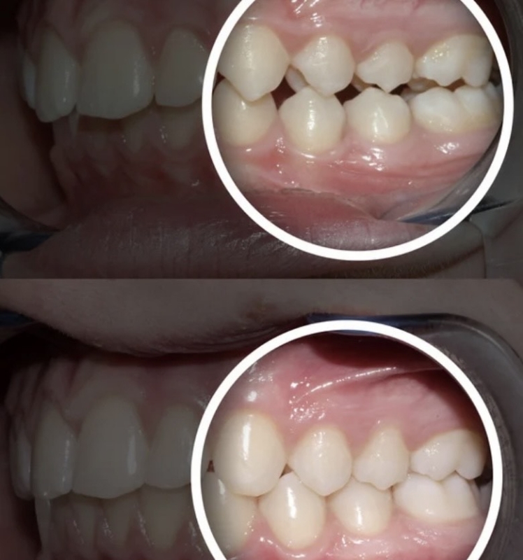 Снимка на Лечение на Клас II малоклузия – съвременни подходи от детска до зряла възраст